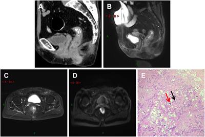 Conjoint analysis of clinical, imaging, and pathological features of schistosomiasis and colorectal cancer
